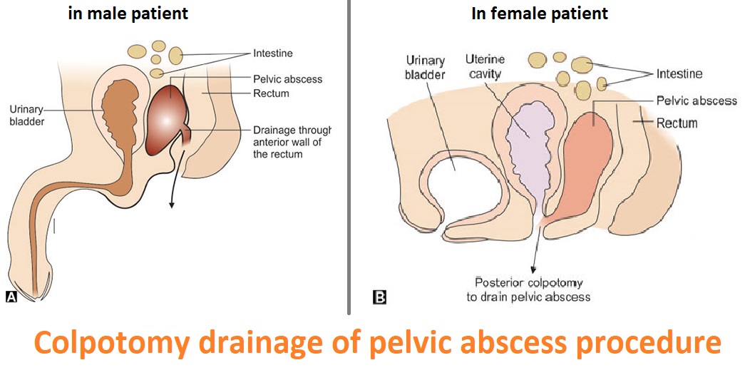 Drainage Of Pelvic Abcess (Colpotomy)treatment cost in Delhi| Drainage Of Pelvic Abcess (Colpotomy) treatment cost in India| Delhi| Mumbai| Gurgaon| Satyughealthcare.com