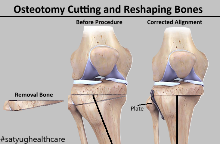 Osteotomy Deformity Correction Surgery Cost in India (reshape or realign bone)