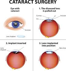 Cataract Surgery treatment cost in Delhi| Cataract Surgery treatment cost in India| Delhi| Mumbai| Gurgaon| Satyughealthcare.com