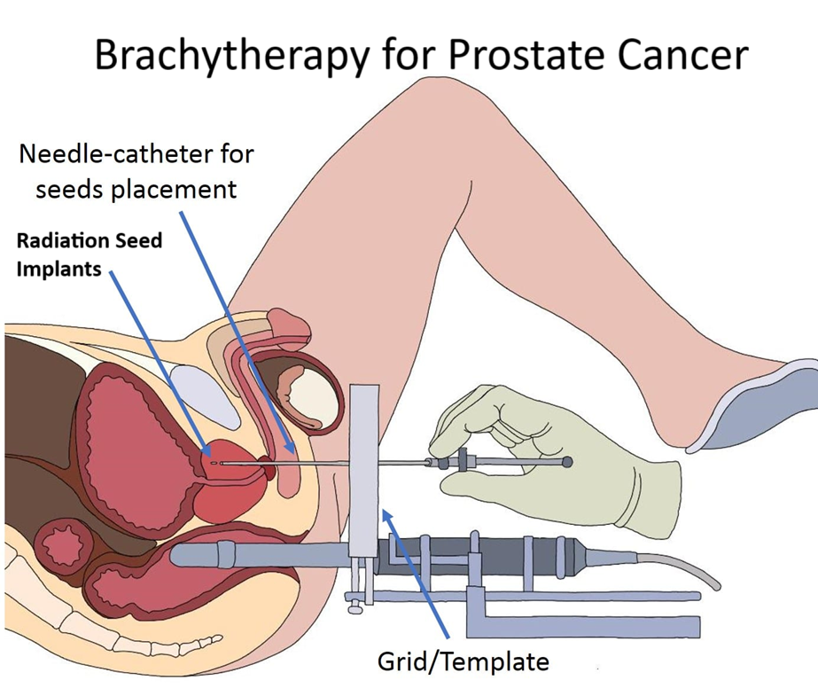 brachytherapy cost in India