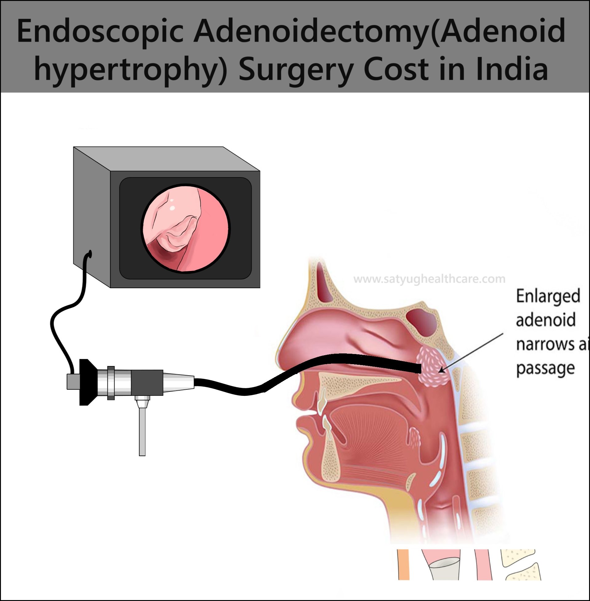 Adenoids After Child S Surgery YDRFM