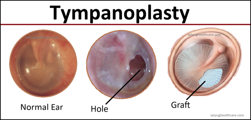 Tympanoplasty Surgery Cost In India Tympanoplasty Surgery Cost In India