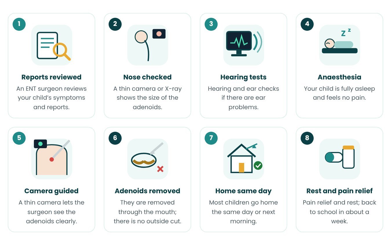 Endoscopic Adenoidectomy step by step in pictures