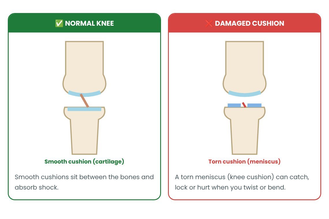 Arthroscopic Meniscectomy: normal vs abnormal explained in pictures