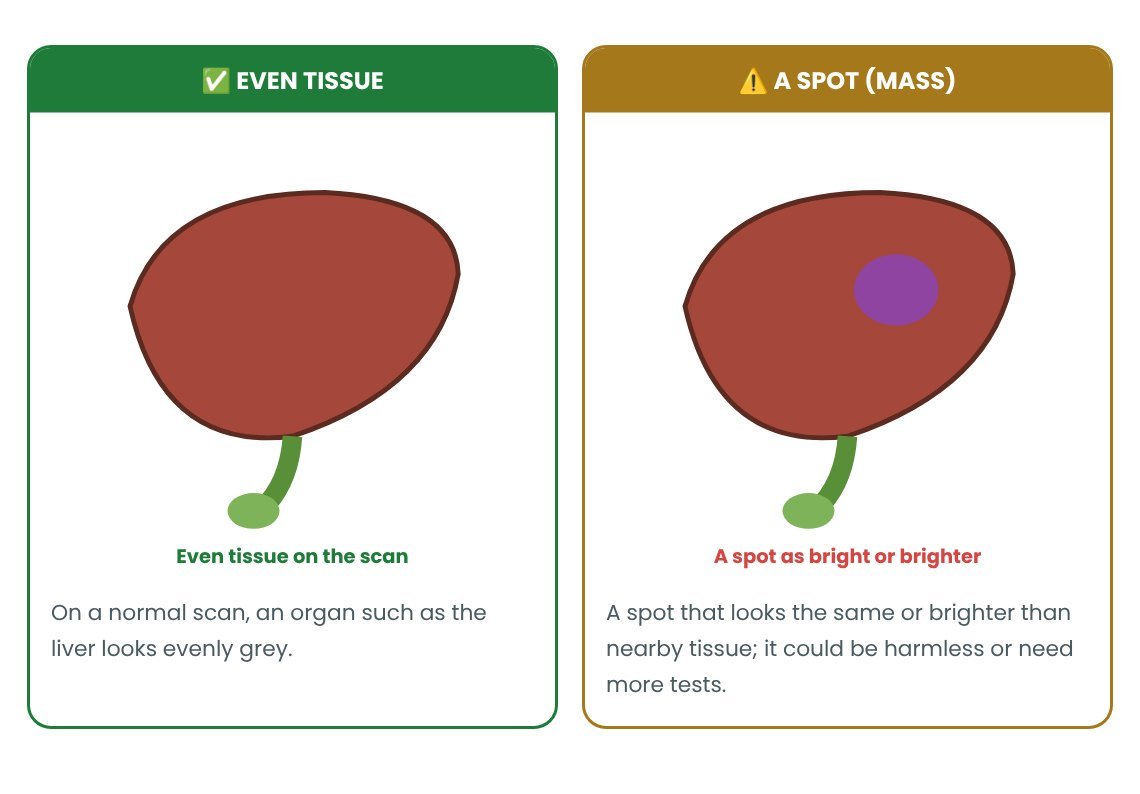 Isohyperechoic Mass on Ultrasound: normal vs abnormal explained in pictures