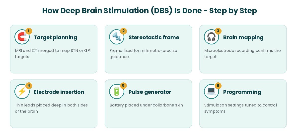 Deep Brain Stimulation (DBS) procedure steps Deep Brain Stimulation (DBS) procedure steps