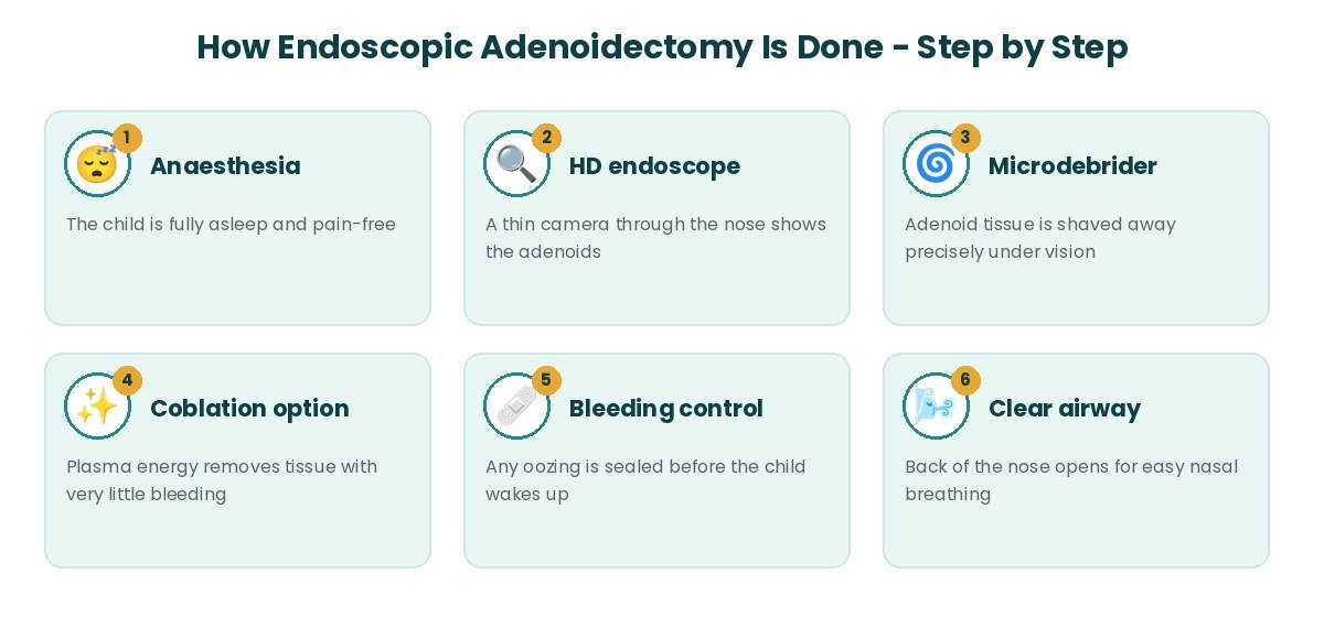 Endoscopic Adenoidectomy procedure steps