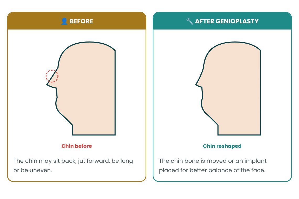 Genioplasty: normal vs abnormal explained in pictures Genioplasty: normal vs abnormal explained in pictures