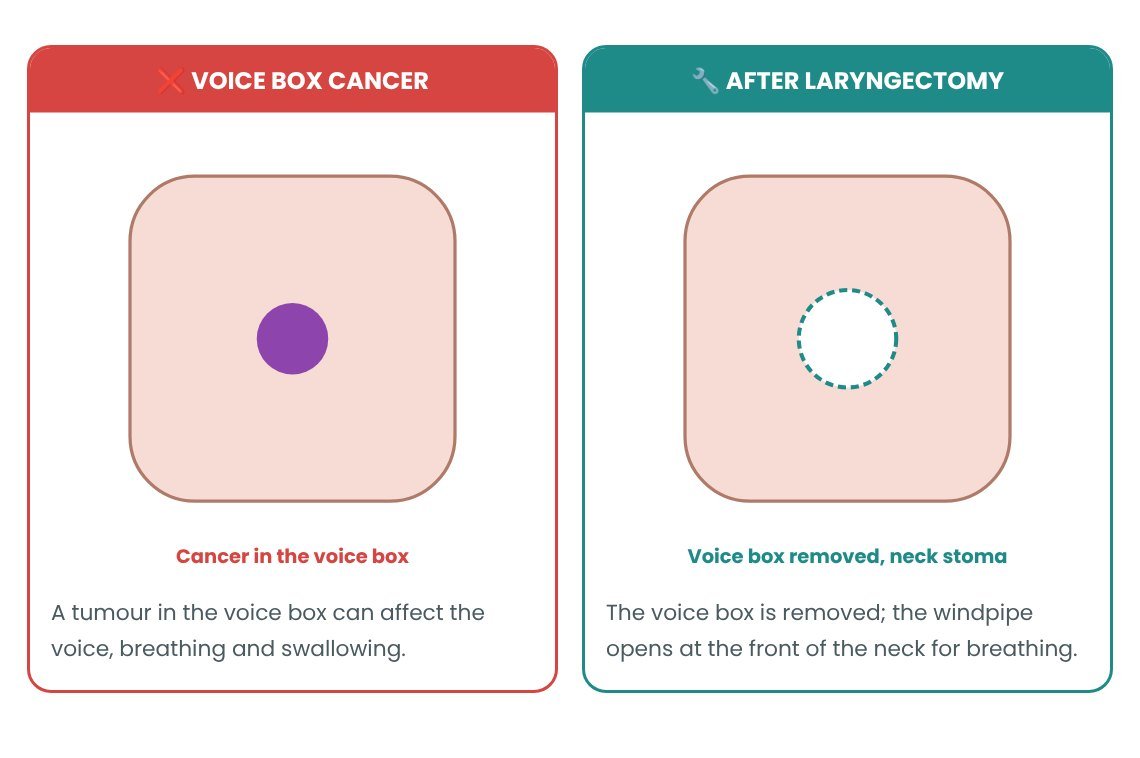 Laryngectomy: normal vs abnormal explained in pictures Laryngectomy: normal vs abnormal explained in pictures