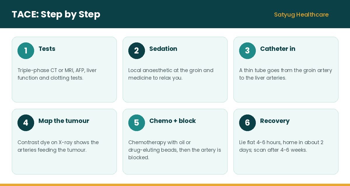 TACE procedure steps for liver cancer