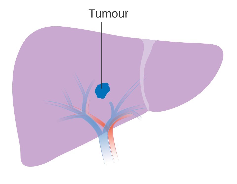 Diagram of stage 1 liver cancer