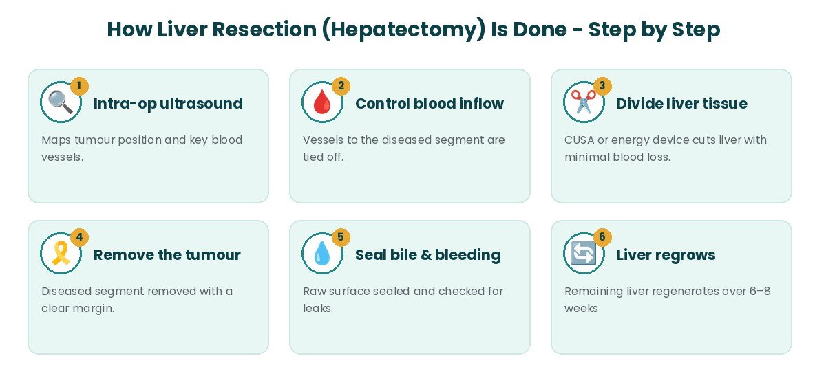 Liver Resection (Hepatectomy) procedure steps