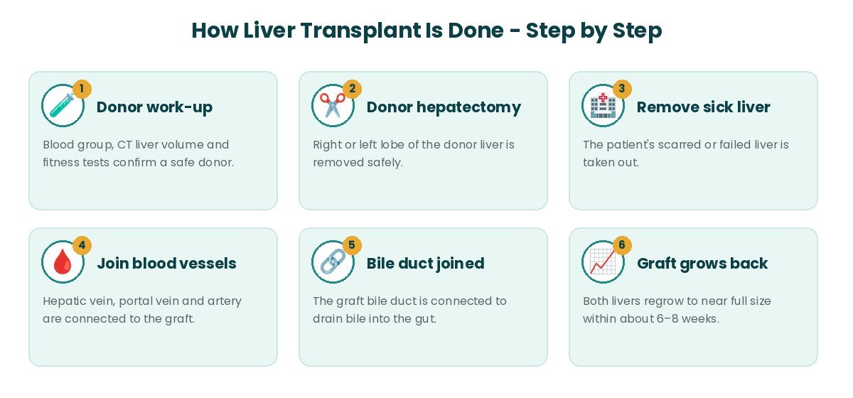 Liver Transplant procedure steps Liver Transplant procedure steps