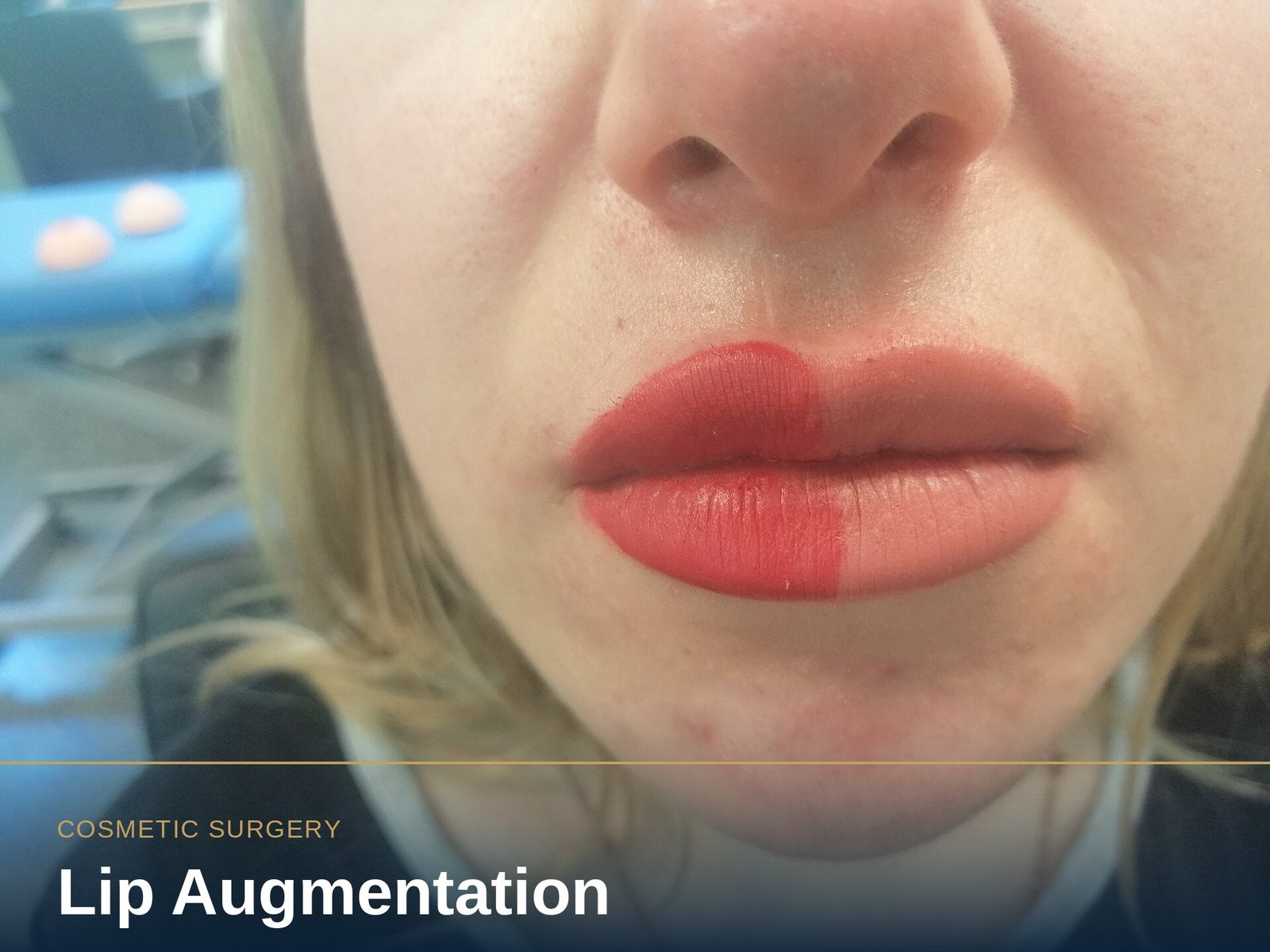 Lip Augmentation