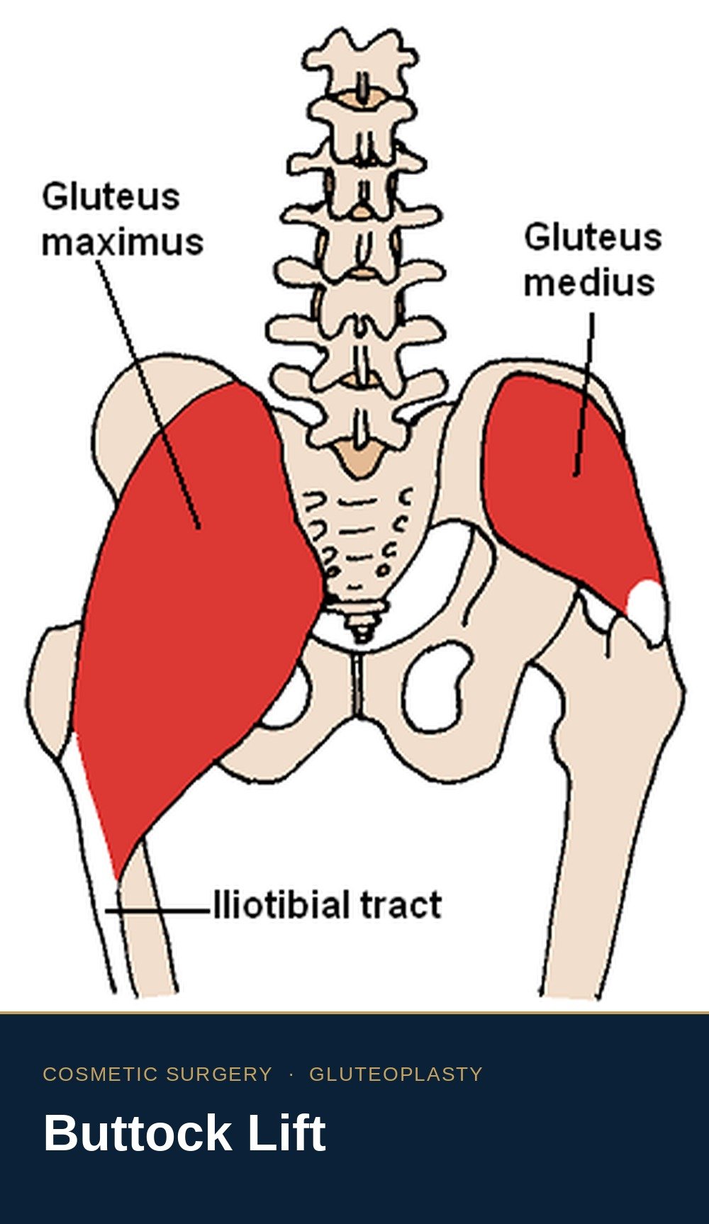 Buttocks Lift
