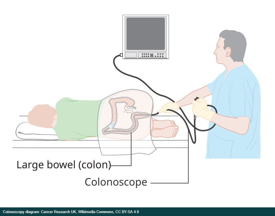 Diagram showing how a colonoscopy is done Diagram showing how a colonoscopy is done