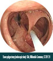 Snare polypectomy endoscopic view Snare polypectomy endoscopic view