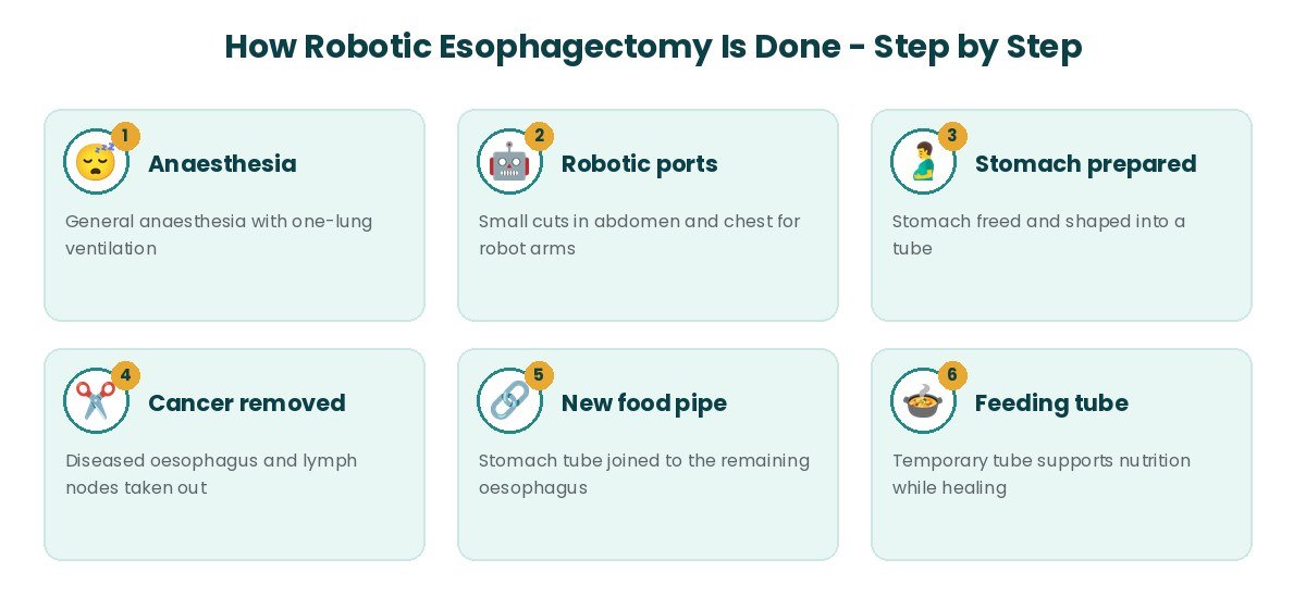 Robotic Esophagectomy procedure steps Robotic Esophagectomy procedure steps