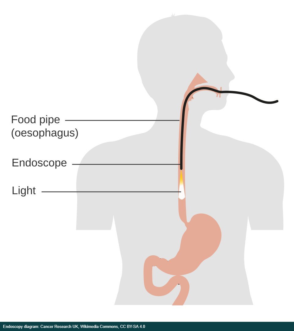 Diagram showing an upper GI endoscopy Diagram showing an upper GI endoscopy