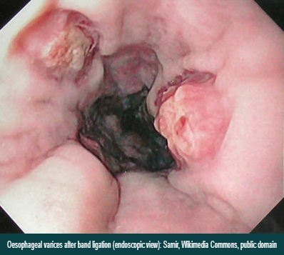 Oesophageal varices after band ligation endoscopic view Oesophageal varices after band ligation endoscopic view